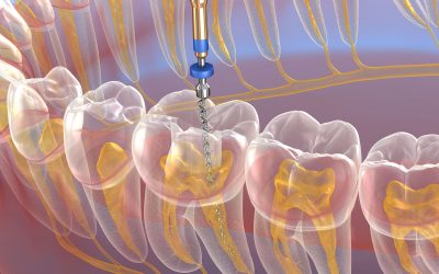 Terapia conservativa endodonzia